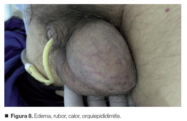 orquiepididimitis