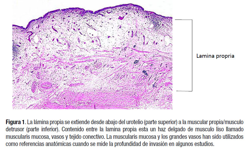 Cáncer de Vejiga