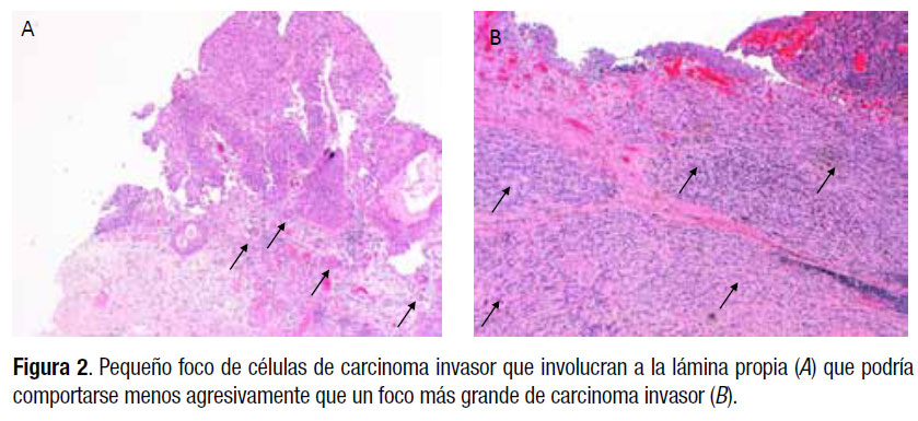 Cáncer de Vejiga