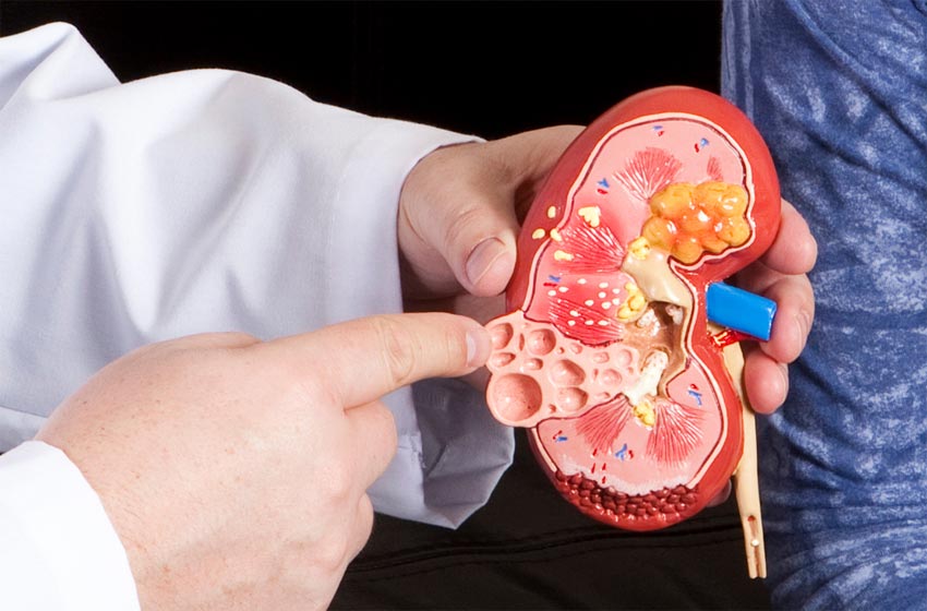 Urólogo en Cali cálculos urinarios