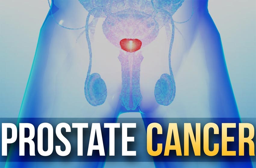 Urólogo en Cali Cáncer de Próstata