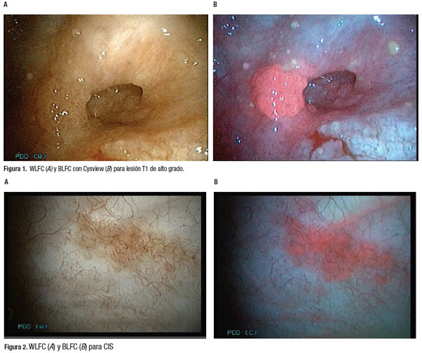 Urologo en Cali cancer de vejiga