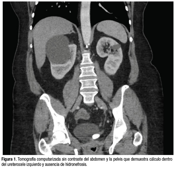 Urologo en Cali manejo del cálculo en un ureterocele adulto