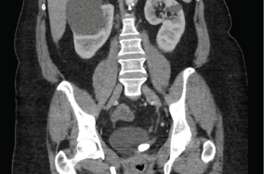 Urologo en Cali manejo del cálculo en un ureterocele adulto