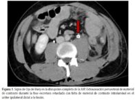 Urologo en Cali Signo de Ojo de Buey después del Trauma Renal