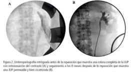 Urologo en Cali Signo de Ojo de Buey después del Trauma Renal
