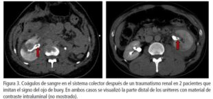 Urologo en Cali Signo de Ojo de Buey después del Trauma Renal