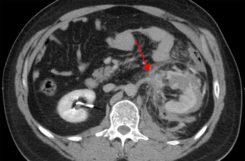 Urologo en Cali Signo de Ojo de Buey después del Trauma Renal