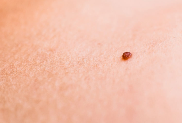 Claves para prevenir las verrugas genitales